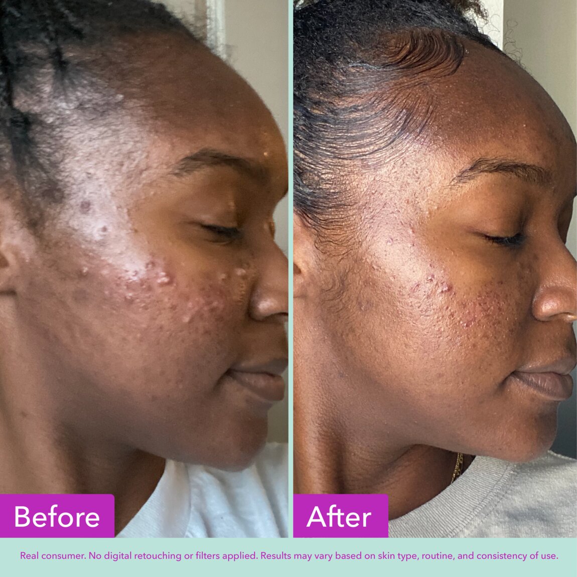 acne-foaming-cleanser-n0 zb_p.jpg