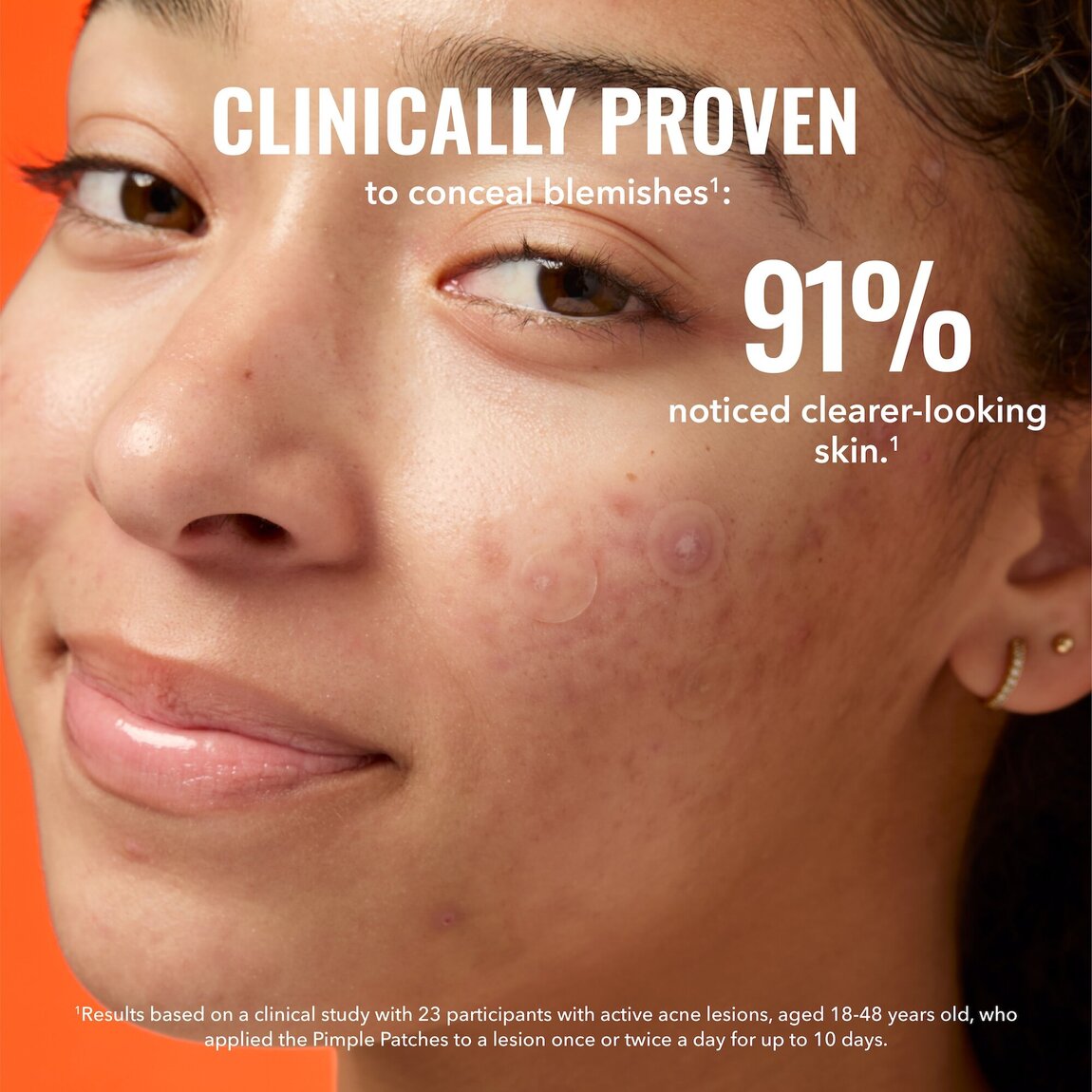 pimple-patches-c1 zb_p.jpg